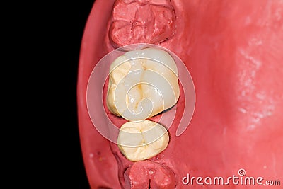 Ceramic molar onlay Stock Photo