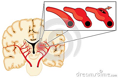Cerebral aneurysm Vector Illustration