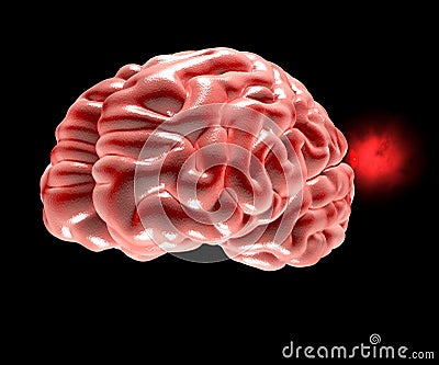 Cerebral aneurysm, brain head Stock Photo