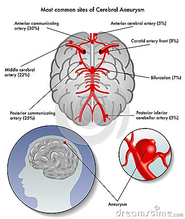 Cerebral aneurysm Vector Illustration