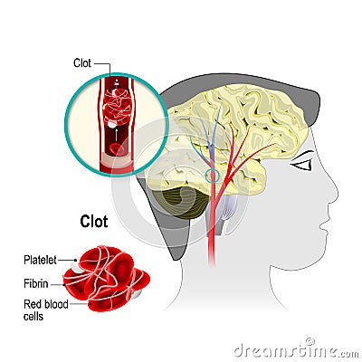 Cerebral infarction Vector Illustration