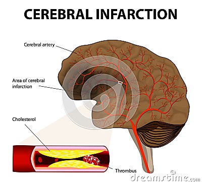 Cerebral infarction or ischemic stroke Vector Illustration