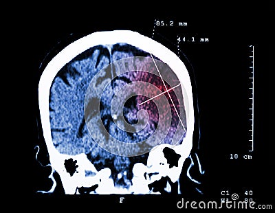 Cerebral infarction at left hemisphere ( Ischemic stroke ) ( CT-scan of brain ) : Medicine and Science background Stock Photo