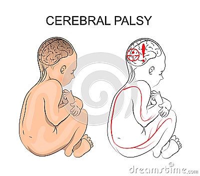 Cerebral palsy. neurology Vector Illustration