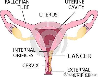 Cervical Cancer. Carcinoma of Cervix. Malignant neoplasm arising from cells in the cervix uteri Stock Photo