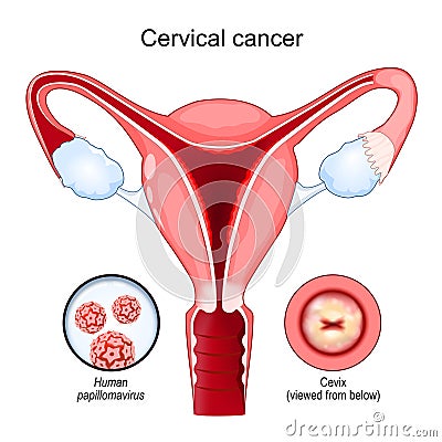 Cervical cancer. Carcinoma. Malignant Vector Illustration