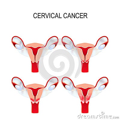 Cervical cancer staging. Carcinoma of Cervix. Vector Illustration