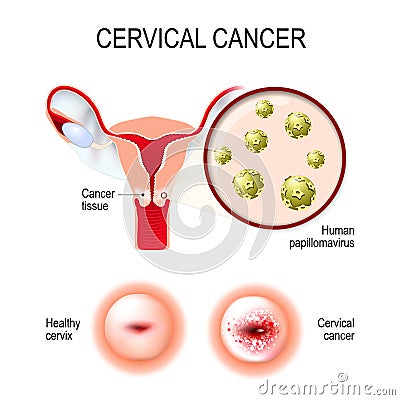 Cervical cancer. uterus, cervix, and close-up of the Human papillomavirus Vector Illustration