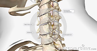 Cervical disc degeneration, or cervical disc disease, is a process that occurs naturally with age Stock Photo