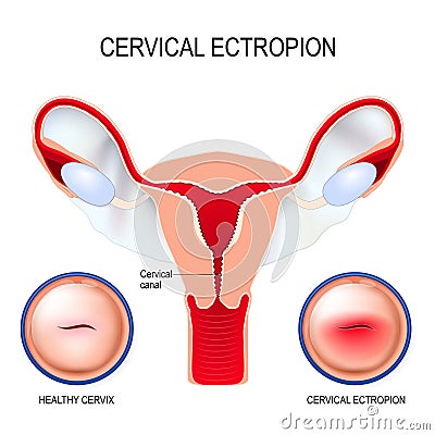 Cervical ectropion. cervical erosion Vector Illustration