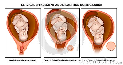 Cervical effacement and dilatation Vector Illustration