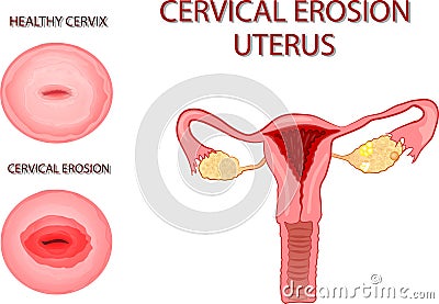 CERVICAL EROSION. The UTERUS Stock Photo