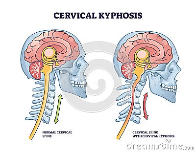 Cervical kyphosis condition with spine and neck curvature outline diagram Vector Illustration