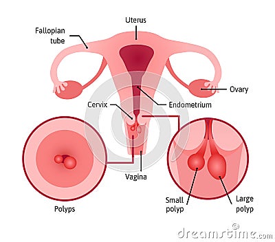 Cervical polyps. Uterus with cervix marked with lines. Small and large polyps are shown in anterior view and inside Vector Illustration