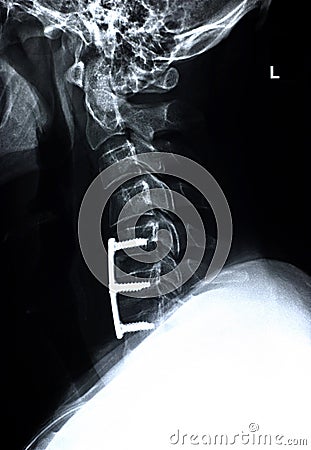 Cervical spine/side Stock Photo