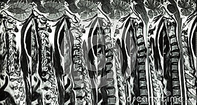 Cervical spondylosis with disc herniation ( MRI of cervical spine : show cervical spondylosis with disc herniation compress spinal Stock Photo