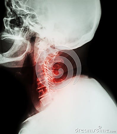 Cervical spondylosis . Film x-ray of cervical spine ( lateral position ) ( side view ) Stock Photo