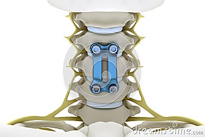 Cervical vertebrae fixed with a metal plate and screws. 3d render image Stock Photo