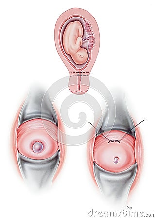 Cervix - Cervical Cerclage Stock Photo