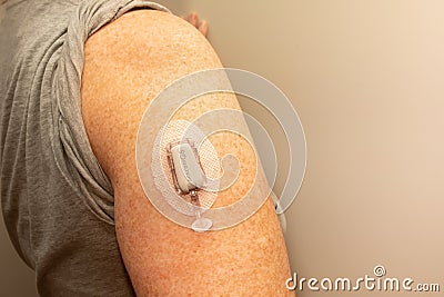 CGM - Continuous glucose monitoring: Dexcom g5 sensor installation on the upper arm. Sensor pod. Editorial Stock Photo