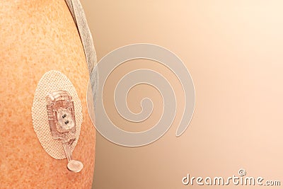 CGM - Continuous glucose monitoring: Sensor installation on the upper arm. Sensor pod and transmitter latch Stock Photo