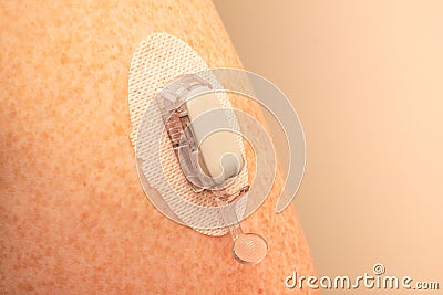CGM - Continuous glucose monitoring: sensor installation on the upper arm. Sensor pod. transmitter and transmitter latch Stock Photo