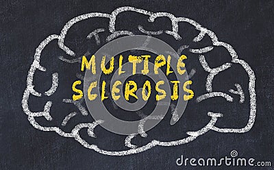 Chalk drawing of human brain with inscription multiple sclerosis Stock Photo