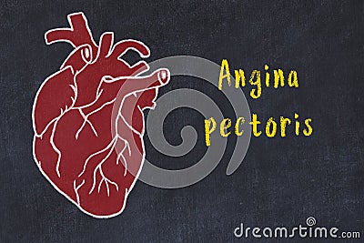 Chalk sketch of human heart on black desc and inscription Angina pectoris Stock Photo