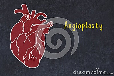 Learning cardio system concept. Chalk drawing of human heart and inscription Angioplasty Stock Photo