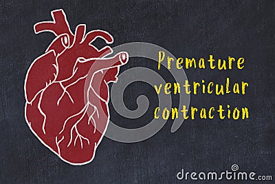 Chalk sketch of human heart on black desc and inscription Premature ventricular contraction Stock Photo