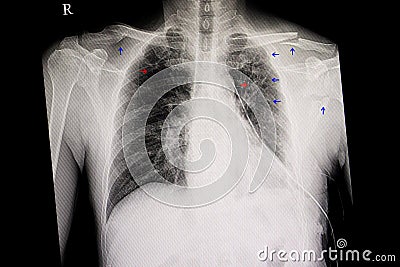Chest film with multiple fracture Stock Photo