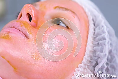 Chemical peeling o the woman`s face. Cleaning the face skin and lightening freckles skin. Close-up face. Side view. Stock Photo