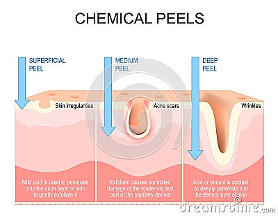 Chemical peels. Exfoliation Vector Illustration