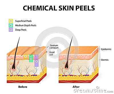 Chemical peels Vector Illustration