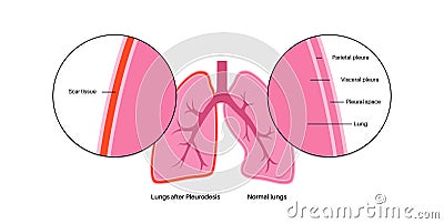 Pleurodesis medical procedure Vector Illustration