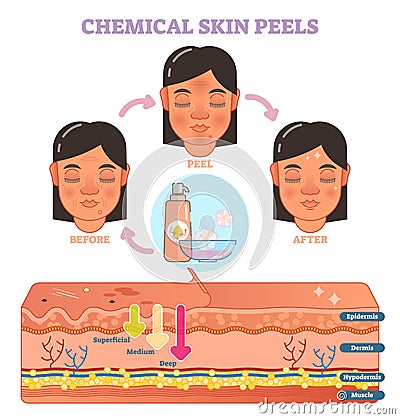 Chemical skin peels vector illustration diagram Vector Illustration