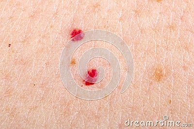 Cherry angioma on human skin Stock Photo
