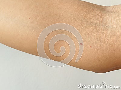 Cherry Angiomas Red mole, Red mark on arm skin, Red dot suddenly appeared. Cherry Hemangioma on arm Stock Photo
