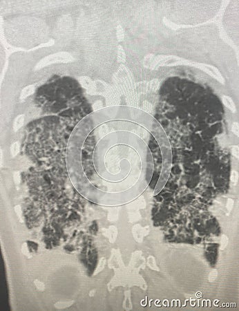 Chest CT Scan of novel Coronavirus COVID-19 Stock Photo