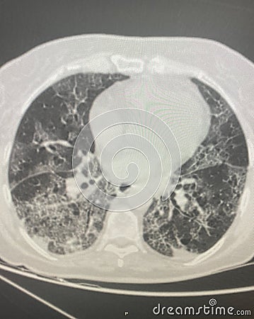 Chest CT Scan of novel Coronavirus COVID-19 Stock Photo