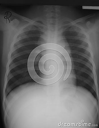 Chest film antero-posterior (AP) view of a 15 years old man with lymphoma, demonstrated both hilar lymph nodes enlargement. Stock Photo