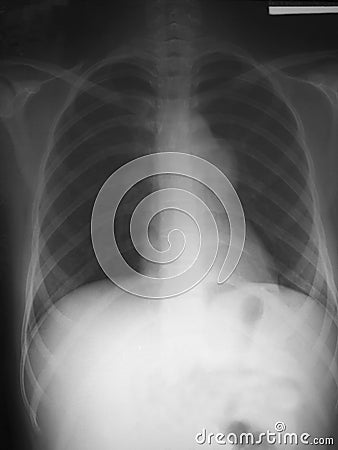 Chest film antero-posterior (AP) view of a 16 years old woman with Hemoglobin H disease (a type of Thalassemia), demonstrated prom Stock Photo