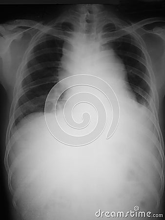 Chest film antero-posterior (AP) view of a 21 years old man, demonstrated mediastinal mass and blunting of left costophrenic angle Stock Photo