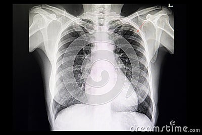 Chest film of a patient with lung nodule Stock Photo