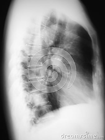 Chest film right lateral view of a 69 years old man, demonstrated right lower lung (RLL) mass. Final diagnosis is carcinoma (CA) Stock Photo