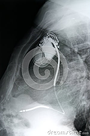 Chest+pacemaker/side Stock Photo