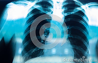 Chest radiography, lung x-ray after a covid 19 infection Stock Photo