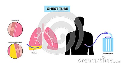 Chest tube catheter Vector Illustration