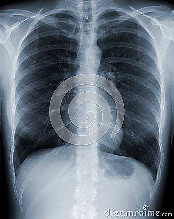 Chest X-Ray Stock Photo