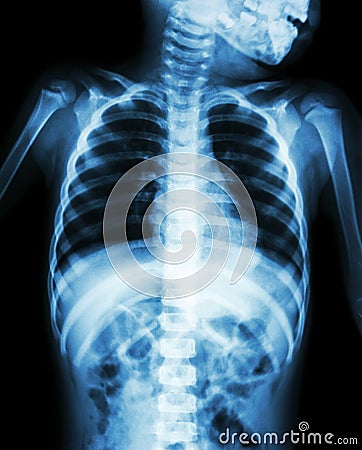 Chest X-ray of child show neck , thorax , shoulder , arm , abdomen Stock Photo